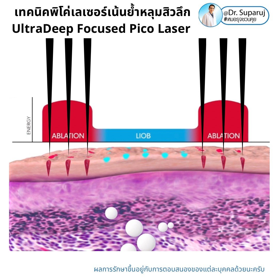 แนะนำเทคนิคดูแลหลุมสิว: เทคนิคพิโค่เลเซอร์เน้นย้ำหลุมสิวลึก UltraDeep Focused Picosecond Laser