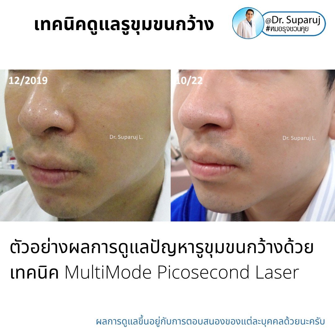 แนะนำเทคนิคดูแลรูขุมขนกว้าง: ตัวอย่างผลการดูแลรูขุมขนกว้าง Enlarged Facial Pore ด้วย MultiMode Picosecond Laser แนะนำเทคนิคดูแลรูขุมขนกว้าง: ตัวอย่างผลการดูแลรูขุมขนกว้าง Enlarged Facial Pore ด้วย MultiMode Picosecond Laser
