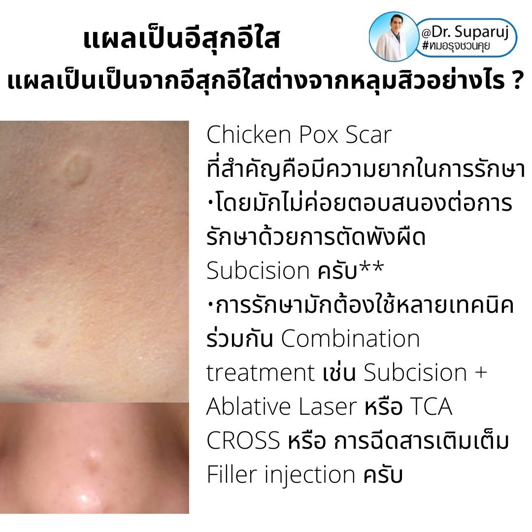 แผลเป็นยุบตัวจากอีสุกอีใส Chicken pox scars ดูแลได้อย่างไร ? แผลเป็นยุบตัวจากอีสุกอีใส Chicken pox scars ดูแลได้อย่างไร ?