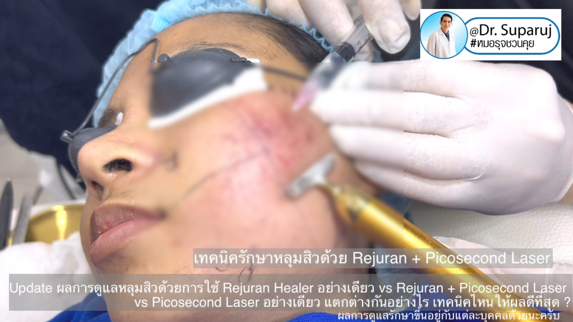 Update ผลการรักษาหลุมสิวด้วยเทคนิค Rejuran Healer อย่างเดียว vs Rejuran + Picosecond Laser vs Picosecond Laser อย่างเดียว แตกต่างกันอย่างไร เทคนิคไหนให้ผลดีที่สุด ? Update ผลการรักษาหลุมสิวด้วยเทคนิค Rejuran Healer อย่างเดียว vs Rejuran + Picosecond Laser vs Picosecond Laser อย่างเดียว แตกต่างกันอย่างไร เทคนิคไหนให้ผลดีที่สุด ?