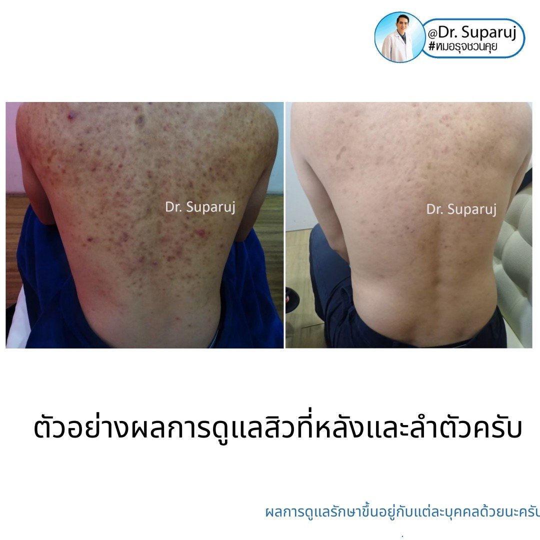 การรักษาเสริม: การรักษาเสริมด้วยหัตถการต่างๆ การรักษาเสริม: การรักษาเสริมด้วยหัตถการต่างๆ