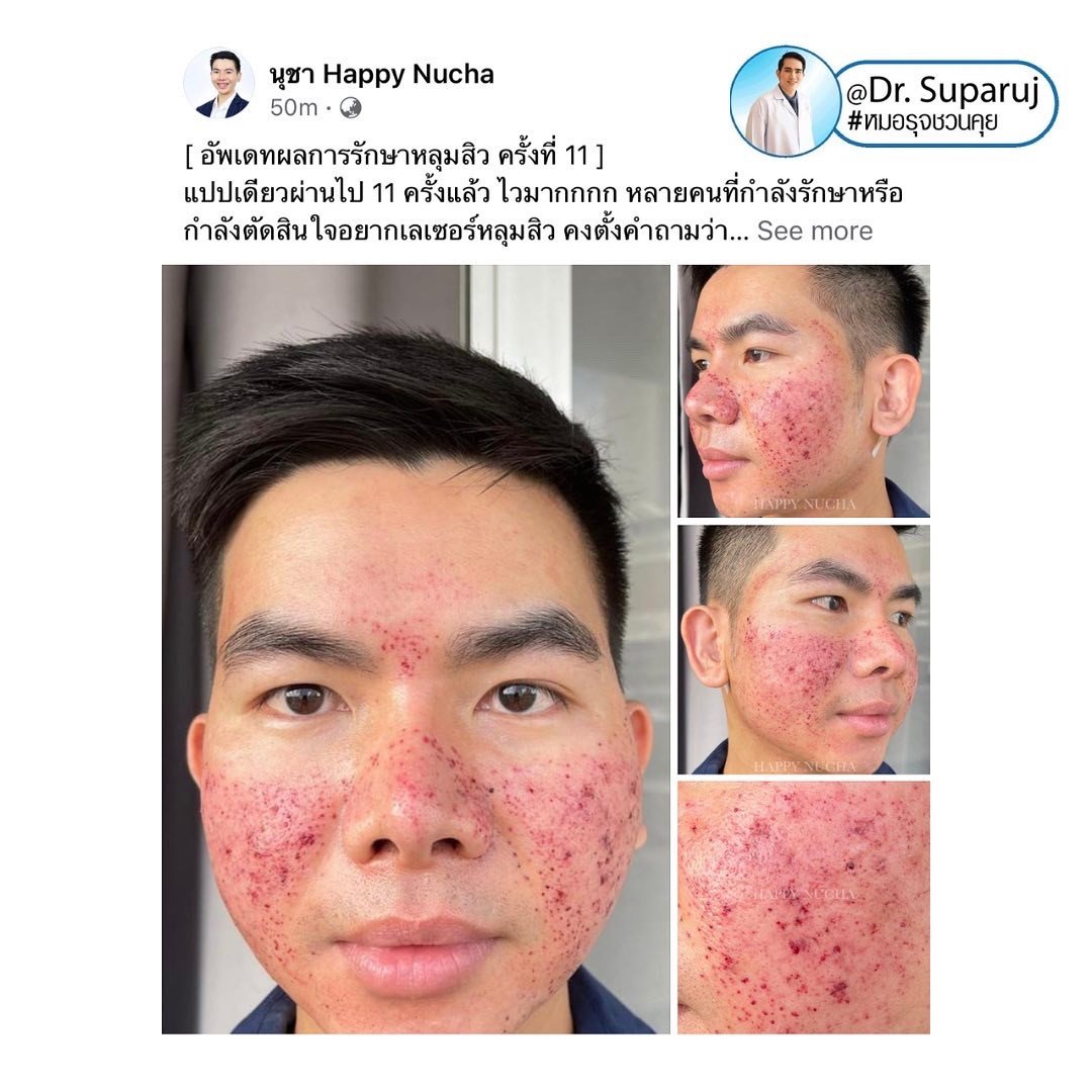 Update ผลการรักษาหลุมสิวด้วย Picosecond Laser VS InfiniRF Microneedle แตกต่างกันอย่างไร อันไหนมีประสิทธิภาพดีกว่า ?