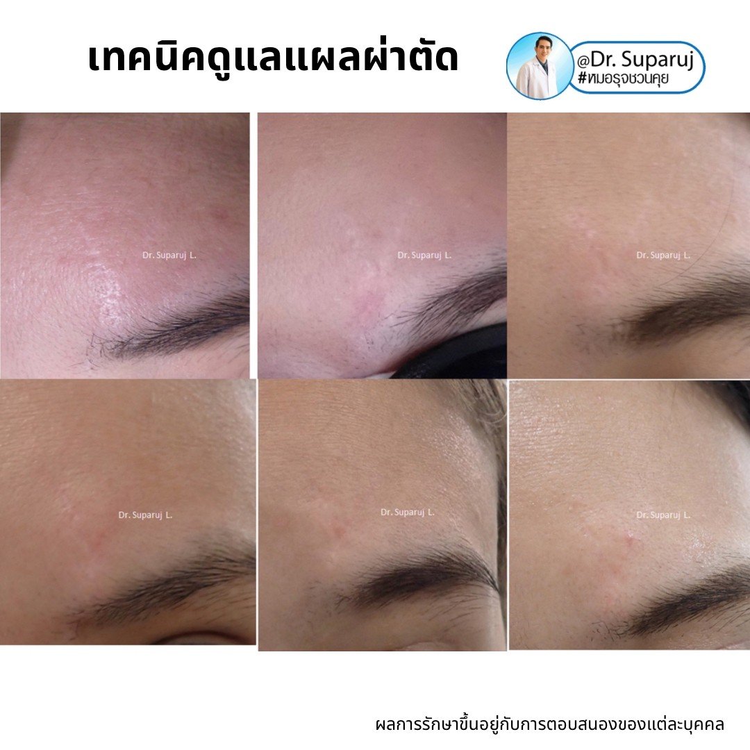 Update เทคนิคดูแลแผลเป็นนูนคีลอยด์ 2022 Update เทคนิคดูแลแผลเป็นนูนคีลอยด์ 2022