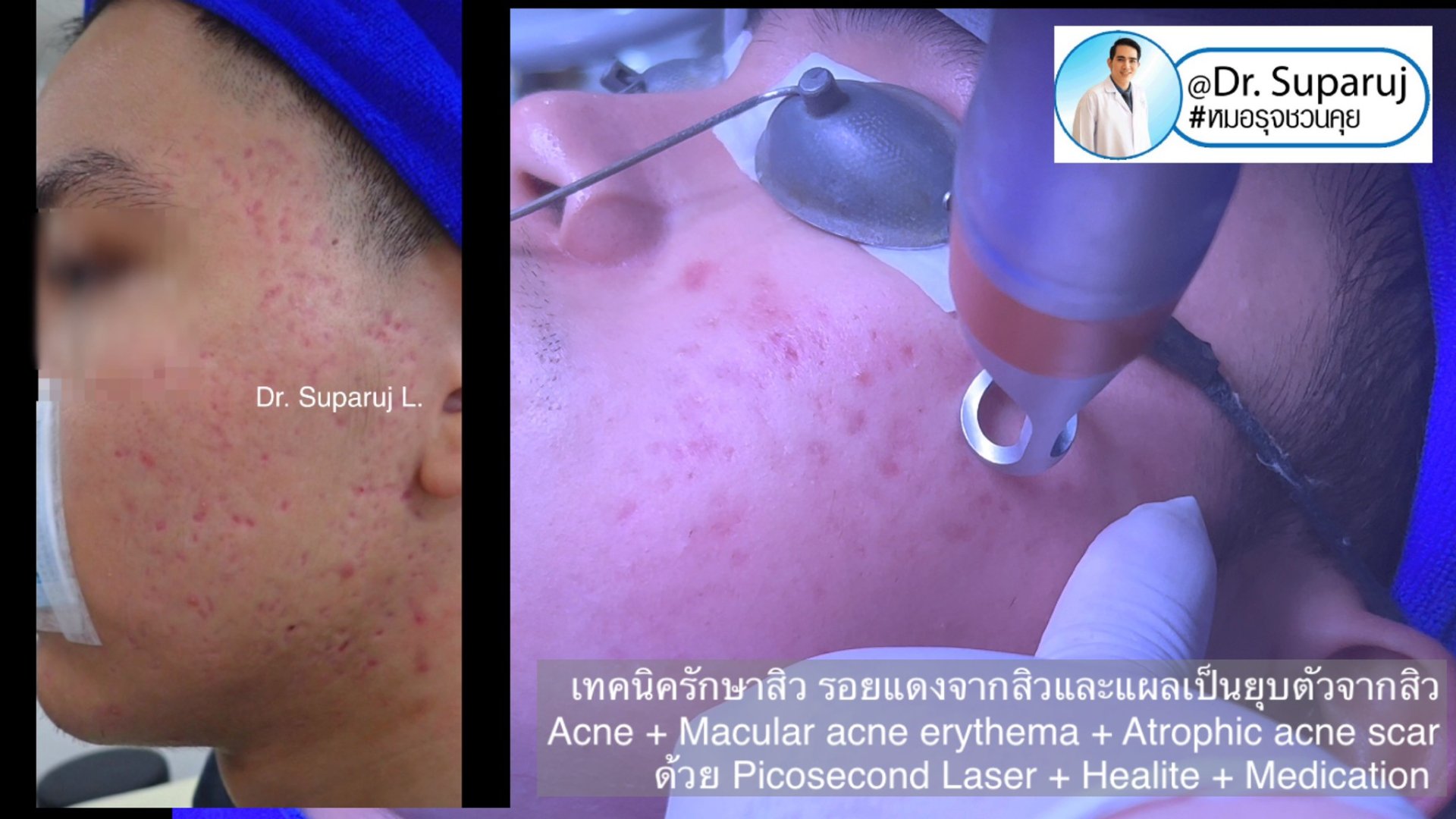 แนะนำเทคนิคดูแลรักษาสิวและหลุมสิว: ดูแลรอยแดงจากสิวและแผลเป็นยุบตัวจากสิว Acne + Macular acne erythema + Atrophic acne scar ดูแลด้วย Picosecond Laser + Healite + Medication