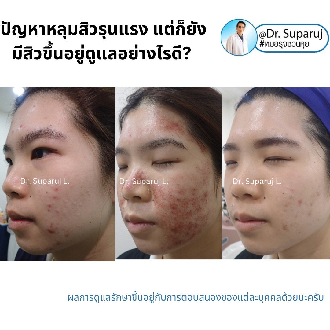 มีปัญหาหลุมสิวรุนแรง แต่ก็ยังมีสิวขึ้นอยู่ดูแลอย่างไรดี สามารถทำเลเซอร์รักษาหลุมสิวได้เลยไหม? มีปัญหาหลุมสิวรุนแรง แต่ก็ยังมีสิวขึ้นอยู่ดูแลอย่างไรดี สามารถทำเลเซอร์รักษาหลุมสิวได้เลยไหม?