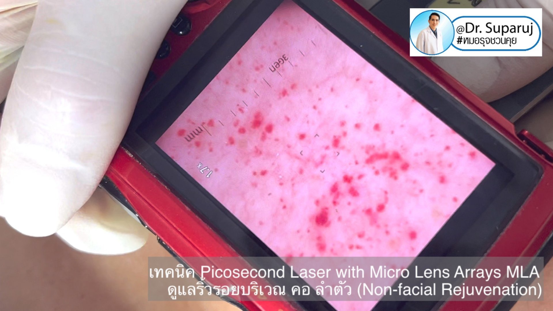 แนะนำ เทคนิคการใช้เลเซอร์ Picosecond Laser with Micro Lens Arrays MLA เพื่อดูแลริ้วรอยบริเวณ คอ ลำตัว (Non-facial rejuvenation) แนะนำ เทคนิคการใช้เลเซอร์ Picosecond Laser with Micro Lens Arrays MLA เพื่อดูแลริ้วรอยบริเวณ คอ ลำตัว (Non-facial rejuvenation)