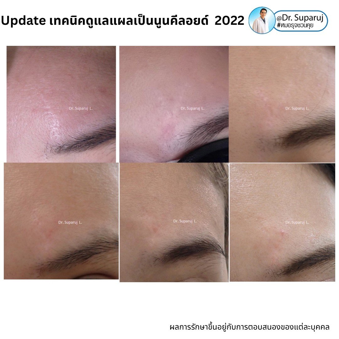 Update เทคนิคดูแลแผลเป็นนูนคีลอยด์ 2022 Update เทคนิคดูแลแผลเป็นนูนคีลอยด์ 2022