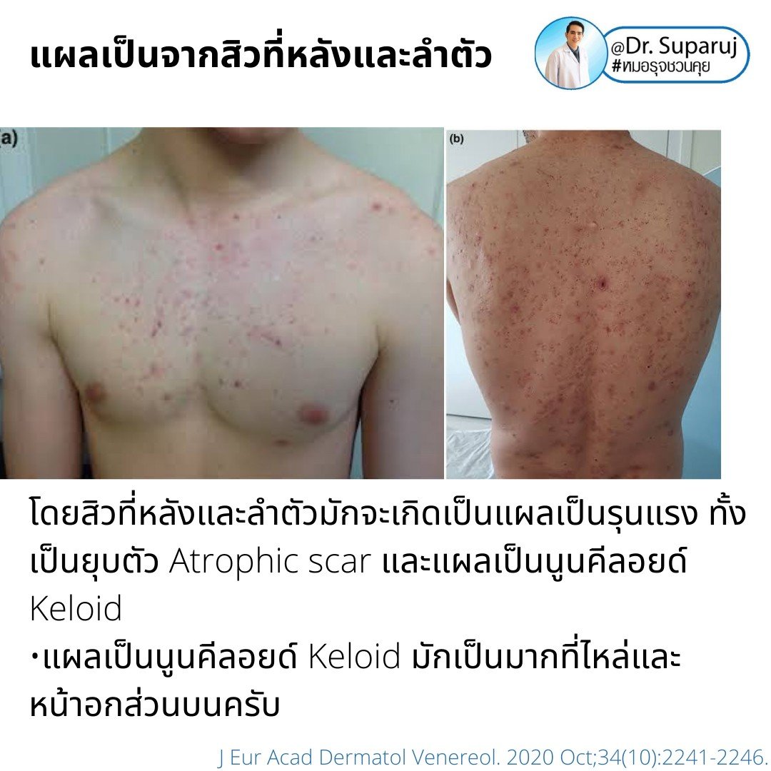 การรักษาเสริม: การรักษาเสริมด้วยหัตถการต่างๆ การรักษาเสริม: การรักษาเสริมด้วยหัตถการต่างๆ