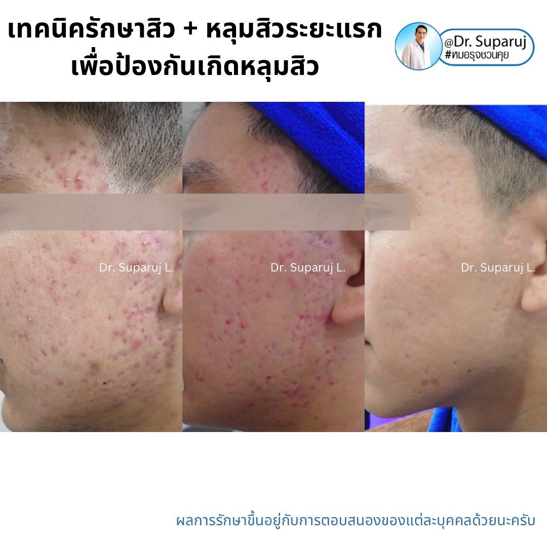 แนะนำเทคนิคดูแลรักษาสิวและหลุมสิว: ดูแลรอยแดงจากสิวและแผลเป็นยุบตัวจากสิว Acne + Macular acne erythema + Atrophic acne scar ดูแลด้วย Picosecond Laser + Healite + Medication แนะนำเทคนิคดูแลรักษาสิวและหลุมสิว: ดูแลรอยแดงจากสิวและแผลเป็นยุบตัวจากสิว Acne + Macular acne erythema + Atrophic acne scar ดูแลด้วย Picosecond Laser + Healite + Medication