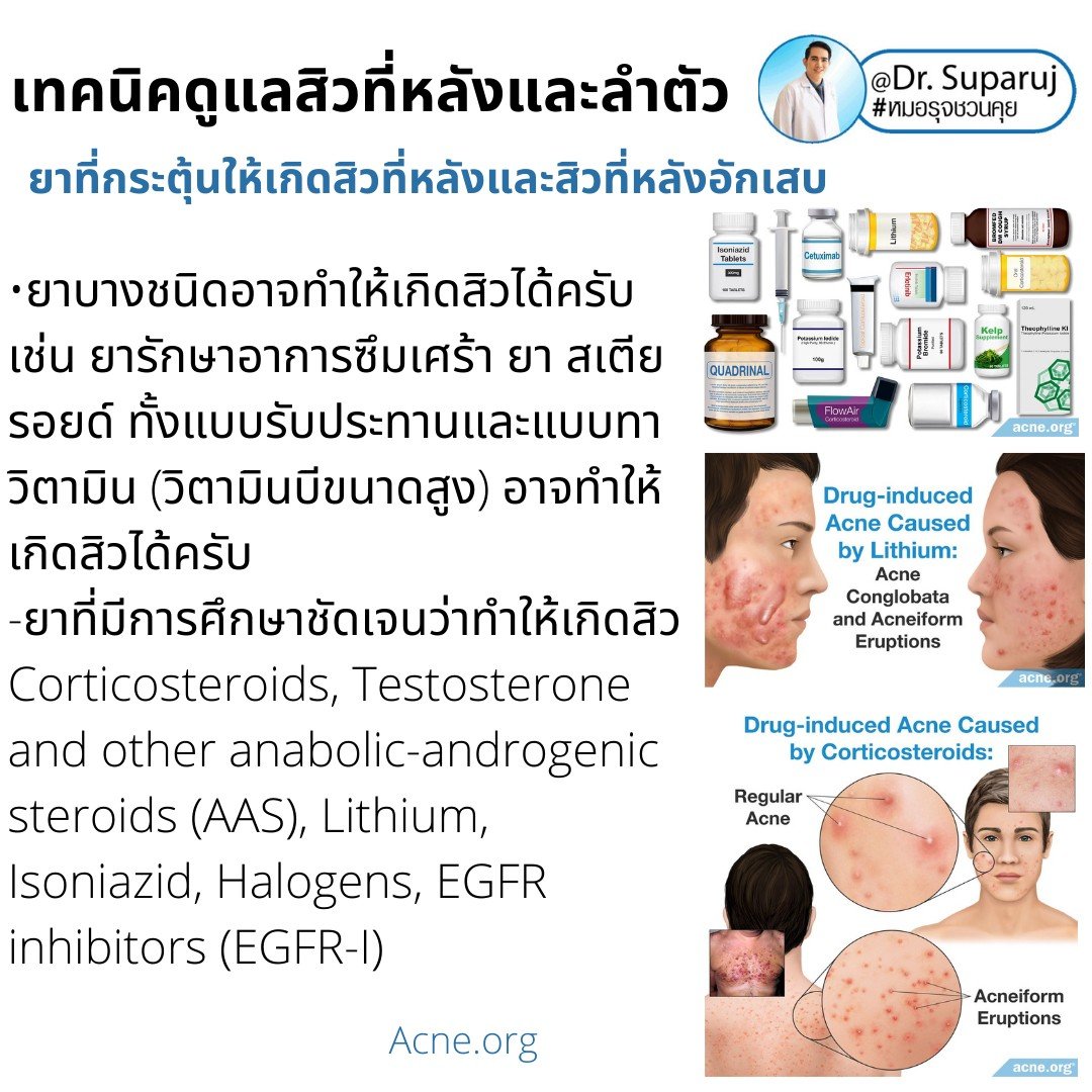 สิวที่หลัง และลำตัว Truncal & Body Acne เกิดจากอะไรและดูแลรักษาได้อย่างไร ? (Update + รีวิว) สิวที่หลัง และลำตัว Truncal & Body Acne เกิดจากอะไรและดูแลรักษาได้อย่างไร ? (Update + รีวิว)