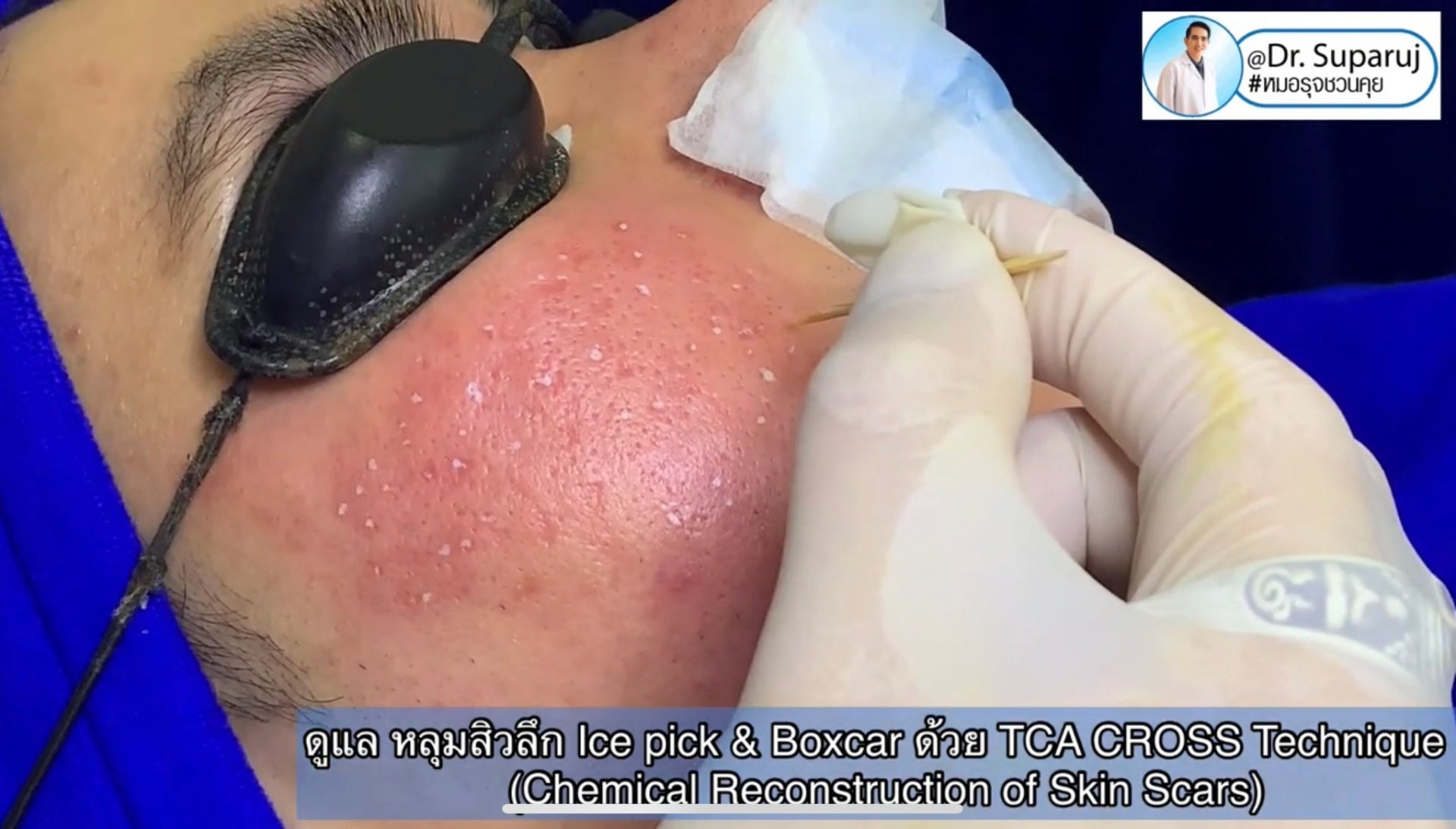 รักษาหลุมสิวด้วยการแต้มกรด TCA แล้วเกิดเป็นรอยดำ เกิดจากอะไรได้บ้าง? รักษาหลุมสิวด้วยการแต้มกรด TCA แล้วเกิดเป็นรอยดำ เกิดจากอะไรได้บ้าง?