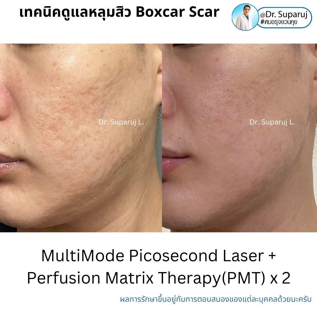 เทคนิคการดูแลหลุมสิว: ตัวอย่างการดูแลหลุมสิวแบบขอบชัดและแบบยุบตัวด้วยการใช้ Picosecond Laser + Perfusion Matrix Therapy เทคนิคการดูแลหลุมสิว: ตัวอย่างการดูแลหลุมสิวแบบขอบชัดและแบบยุบตัวด้วยการใช้ Picosecond Laser + Perfusion Matrix Therapy