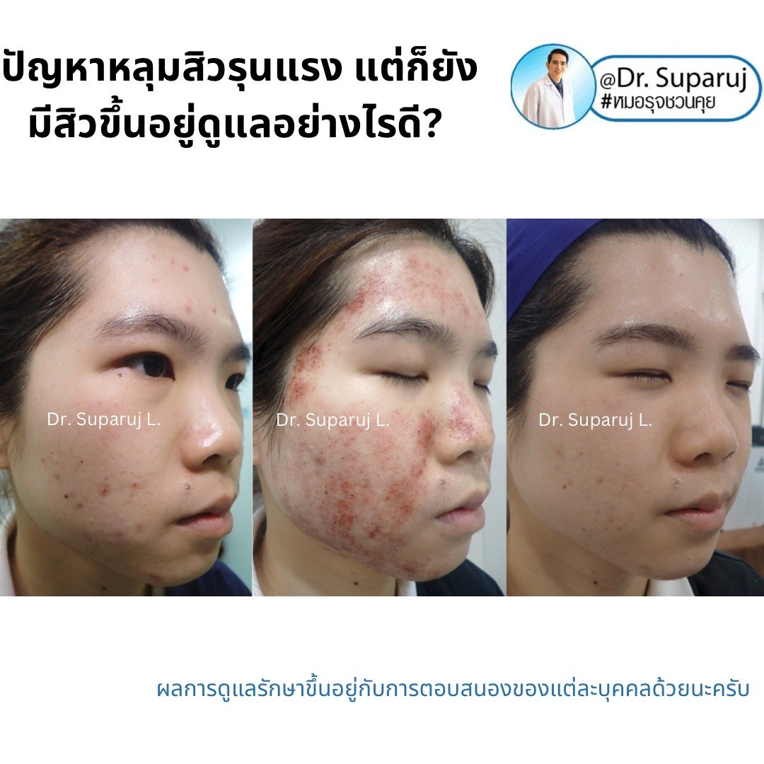 มีปัญหาหลุมสิวรุนแรง แต่ก็ยังมีสิวขึ้นอยู่ดูแลอย่างไรดี สามารถทำเลเซอร์รักษาหลุมสิวได้เลยไหม? มีปัญหาหลุมสิวรุนแรง แต่ก็ยังมีสิวขึ้นอยู่ดูแลอย่างไรดี สามารถทำเลเซอร์รักษาหลุมสิวได้เลยไหม?