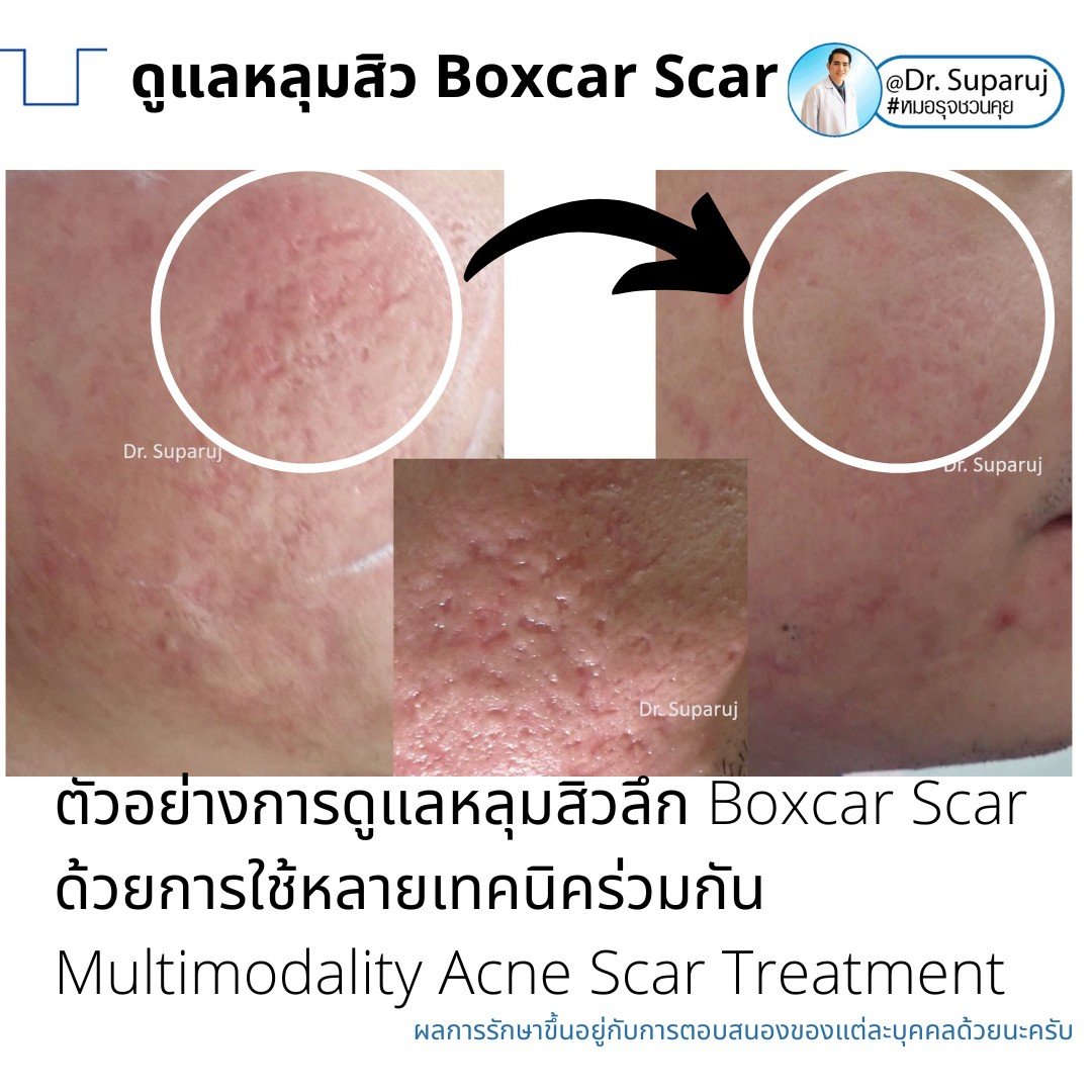 เทคนิคการดูแลหลุมสิว: ตัวอย่างการดูแลหลุมสิวแบบขอบชัดและแบบยุบตัวด้วยการใช้ Picosecond Laser + Perfusion Matrix Therapy เทคนิคการดูแลหลุมสิว: ตัวอย่างการดูแลหลุมสิวแบบขอบชัดและแบบยุบตัวด้วยการใช้ Picosecond Laser + Perfusion Matrix Therapy