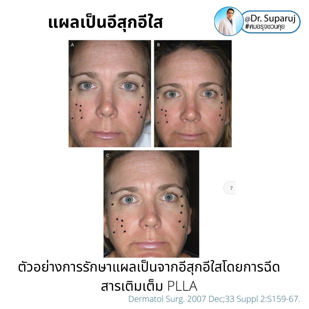 แผลเป็นยุบตัวจากอีสุกอีใส Chicken pox scars ดูแลได้อย่างไร ? แผลเป็นยุบตัวจากอีสุกอีใส Chicken pox scars ดูแลได้อย่างไร ?