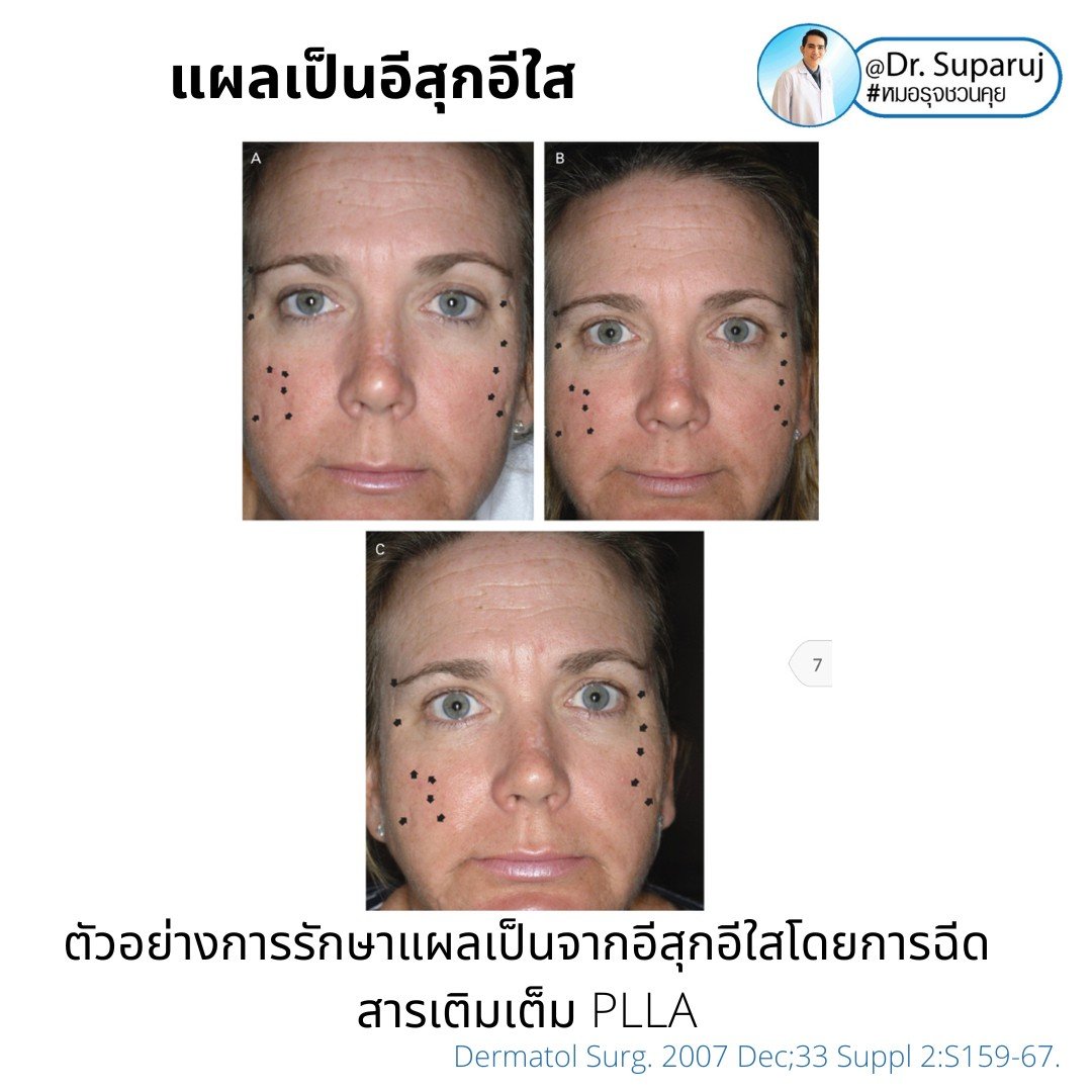 แผลเป็นยุบตัวจากอีสุกอีใส Chicken pox scars ดูแลได้อย่างไร ?