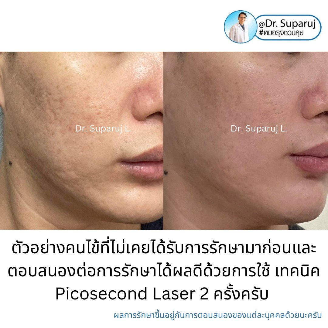 หลุมสิวจำเป็นต้องรักษากี่ครั้ง? ทำไมต้องรักษาหลายครั้ง ? หลุมสิวจำเป็นต้องรักษากี่ครั้ง? ทำไมต้องรักษาหลายครั้ง ?