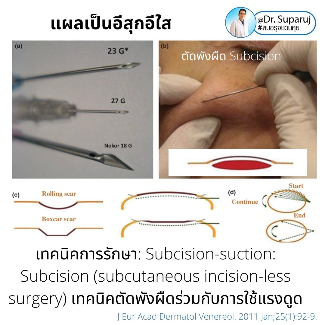 แผลเป็นยุบตัวจากอีสุกอีใส Chicken pox scars ดูแลได้อย่างไร ?