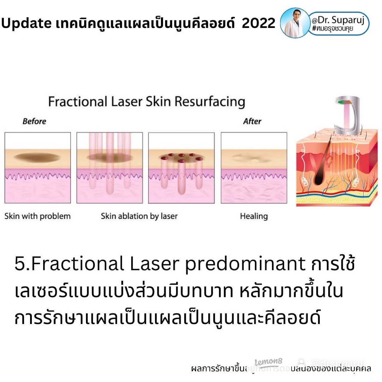 แผลเป็นนูนคีลอยคีลอยด์สามารถรักษาด้วยโดยวิธีผ่าตัดออกได้ไหม ? แผลเป็นนูนคีลอยคีลอยด์สามารถรักษาด้วยโดยวิธีผ่าตัดออกได้ไหม ?
