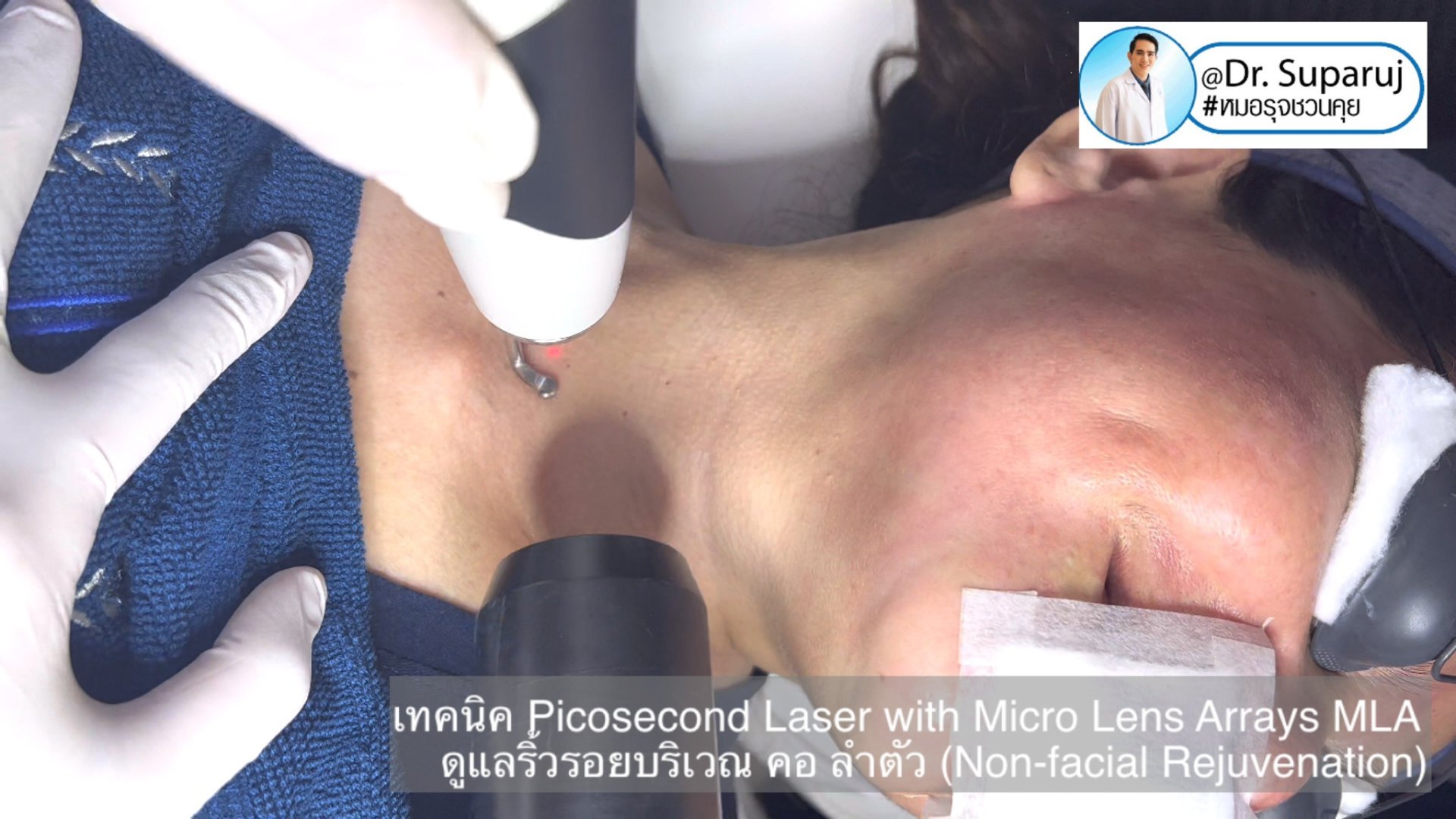 แนะนำ เทคนิคการใช้เลเซอร์ Picosecond Laser with Micro Lens Arrays MLA เพื่อดูแลริ้วรอยบริเวณ คอ ลำตัว (Non-facial rejuvenation) แนะนำ เทคนิคการใช้เลเซอร์ Picosecond Laser with Micro Lens Arrays MLA เพื่อดูแลริ้วรอยบริเวณ คอ ลำตัว (Non-facial rejuvenation)