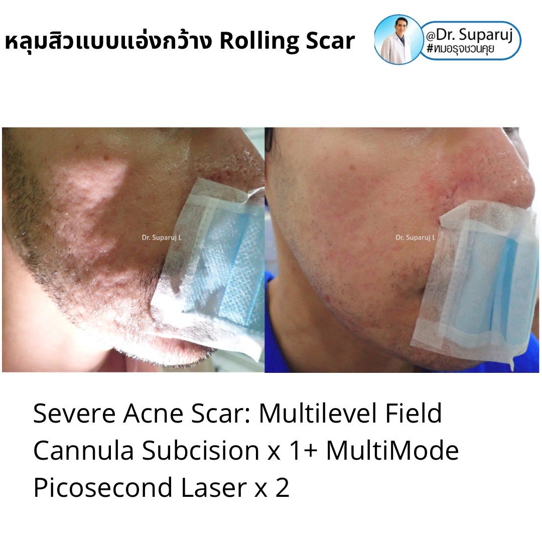 รักษาหลุมสิว ดูผลการรักษา ที่ระยะเวลาเท่าไหร่ดีที่สุด ? รักษาหลุมสิว ดูผลการรักษา ที่ระยะเวลาเท่าไหร่ดีที่สุด ?