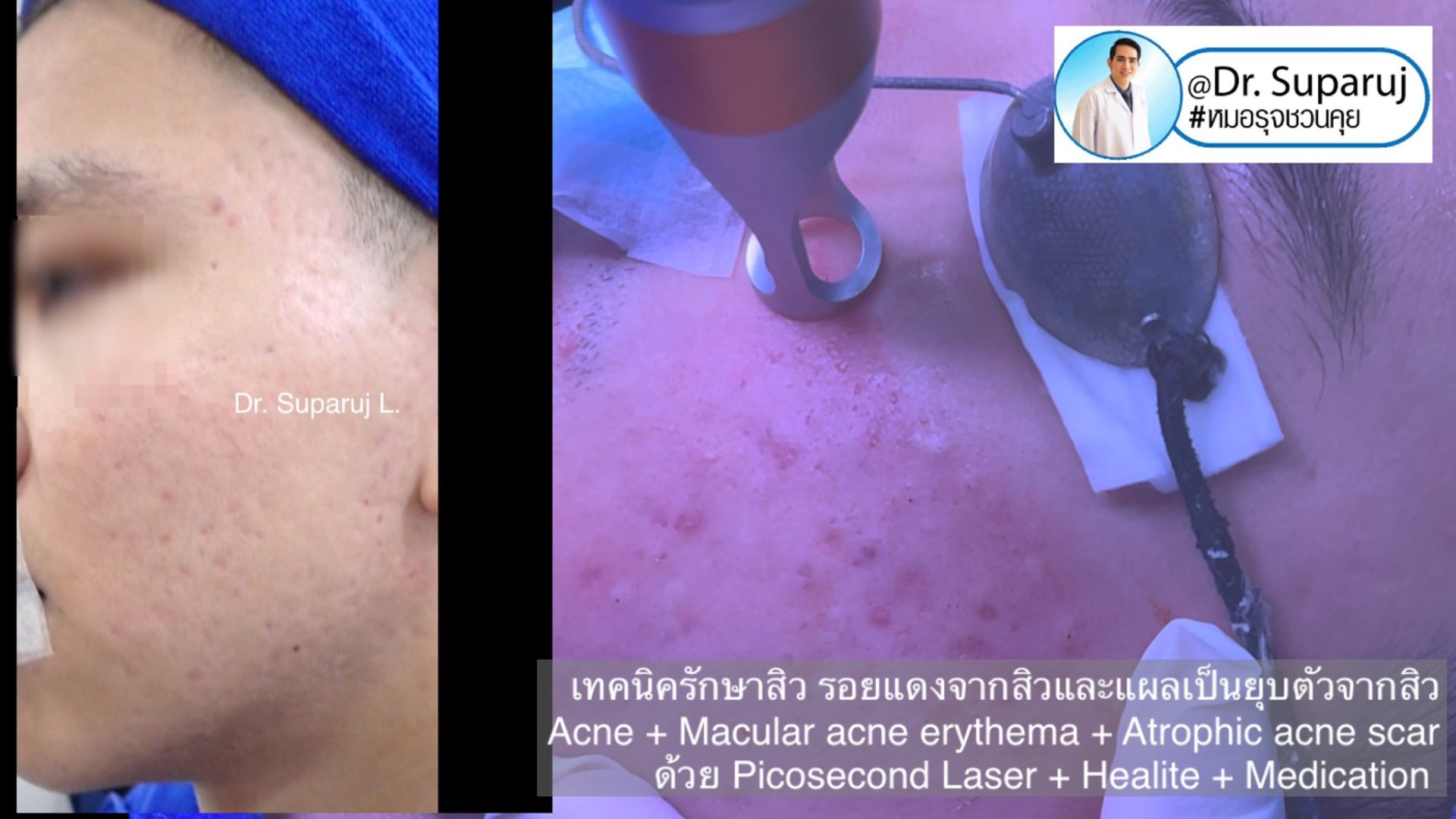 แนะนำเทคนิคดูแลรักษาสิวและหลุมสิว: ดูแลรอยแดงจากสิวและแผลเป็นยุบตัวจากสิว Acne + Macular acne erythema + Atrophic acne scar ดูแลด้วย Picosecond Laser + Healite + Medication