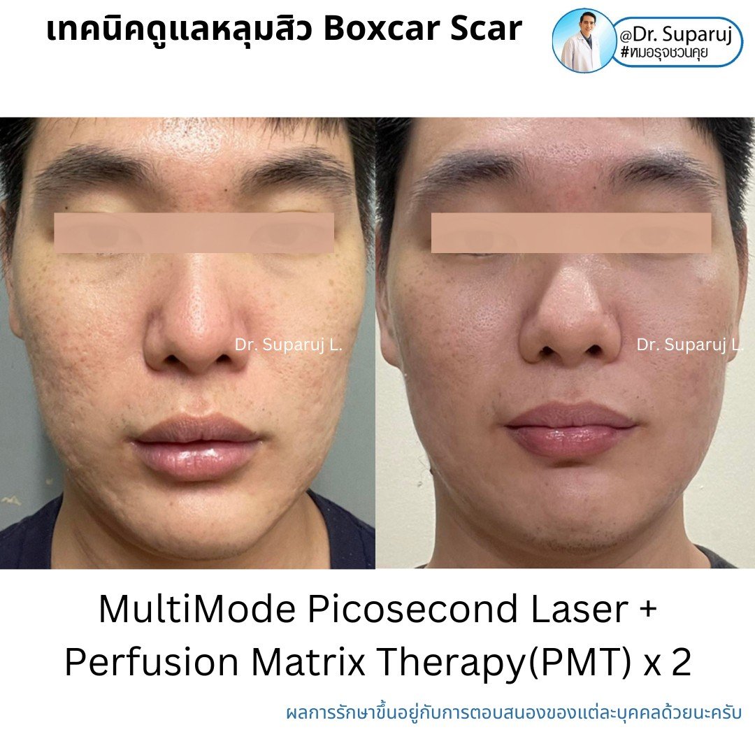 เทคนิคการดูแลหลุมสิว: ตัวอย่างการดูแลหลุมสิวแบบขอบชัดและแบบยุบตัวด้วยการใช้ Picosecond Laser + Perfusion Matrix Therapy เทคนิคการดูแลหลุมสิว: ตัวอย่างการดูแลหลุมสิวแบบขอบชัดและแบบยุบตัวด้วยการใช้ Picosecond Laser + Perfusion Matrix Therapy
