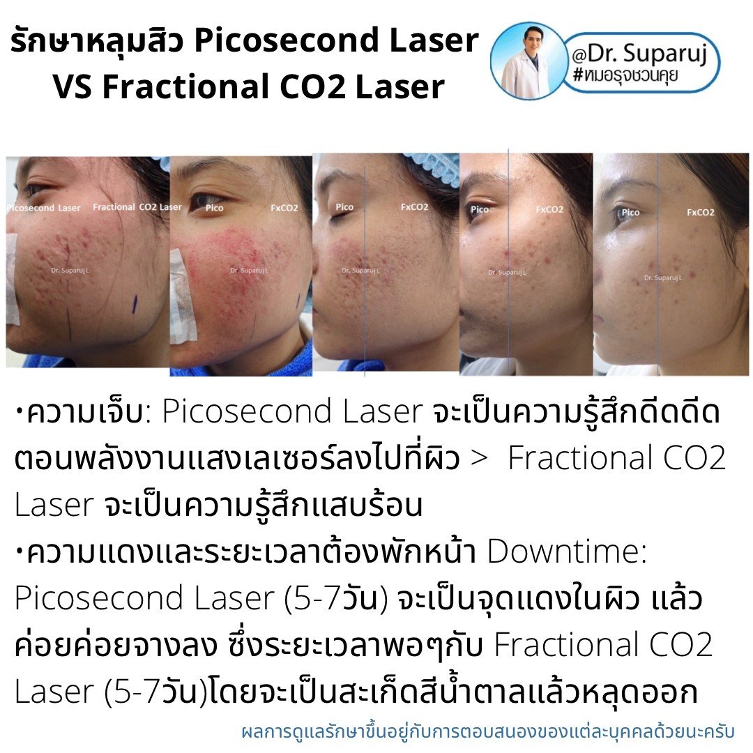 Update ผลการรักษาหลุมสิวด้วยเลเซอร์ Picosecond Laser VS Fractional CO2 Laser ต่างกันอย่างไร? เลเซอร์ชนิดไหนให้ผลดีกว่า? Update ผลการรักษาหลุมสิวด้วยเลเซอร์ Picosecond Laser VS Fractional CO2 Laser ต่างกันอย่างไร? เลเซอร์ชนิดไหนให้ผลดีกว่า?