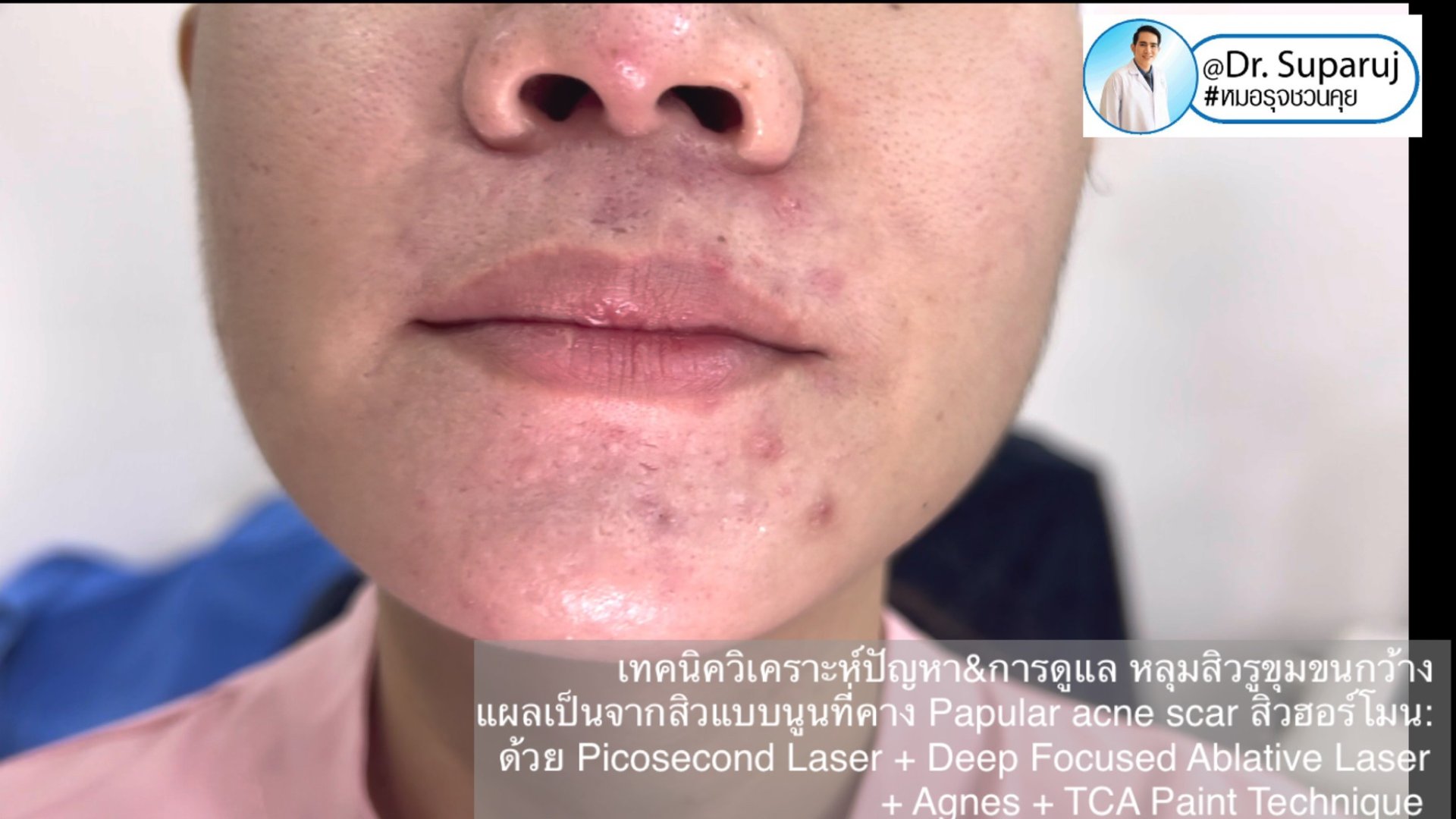 เทคนิควิเคราะห์ปัญหา & รักษาหลุมสิว รูขุมขนกว้าง แผลเป็นจากสิวแบบนูน Papular acne scar สิวฮอร์โมน: ด้วย Picosecond Laser + Deep Focused Ablative Laser + Agnes + TCA Paint Technique