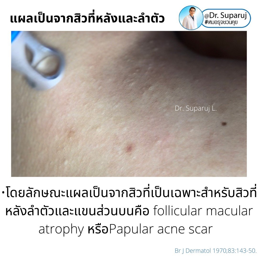 การรักษาเสริม: การรักษาเสริมด้วยหัตถการต่างๆ การรักษาเสริม: การรักษาเสริมด้วยหัตถการต่างๆ