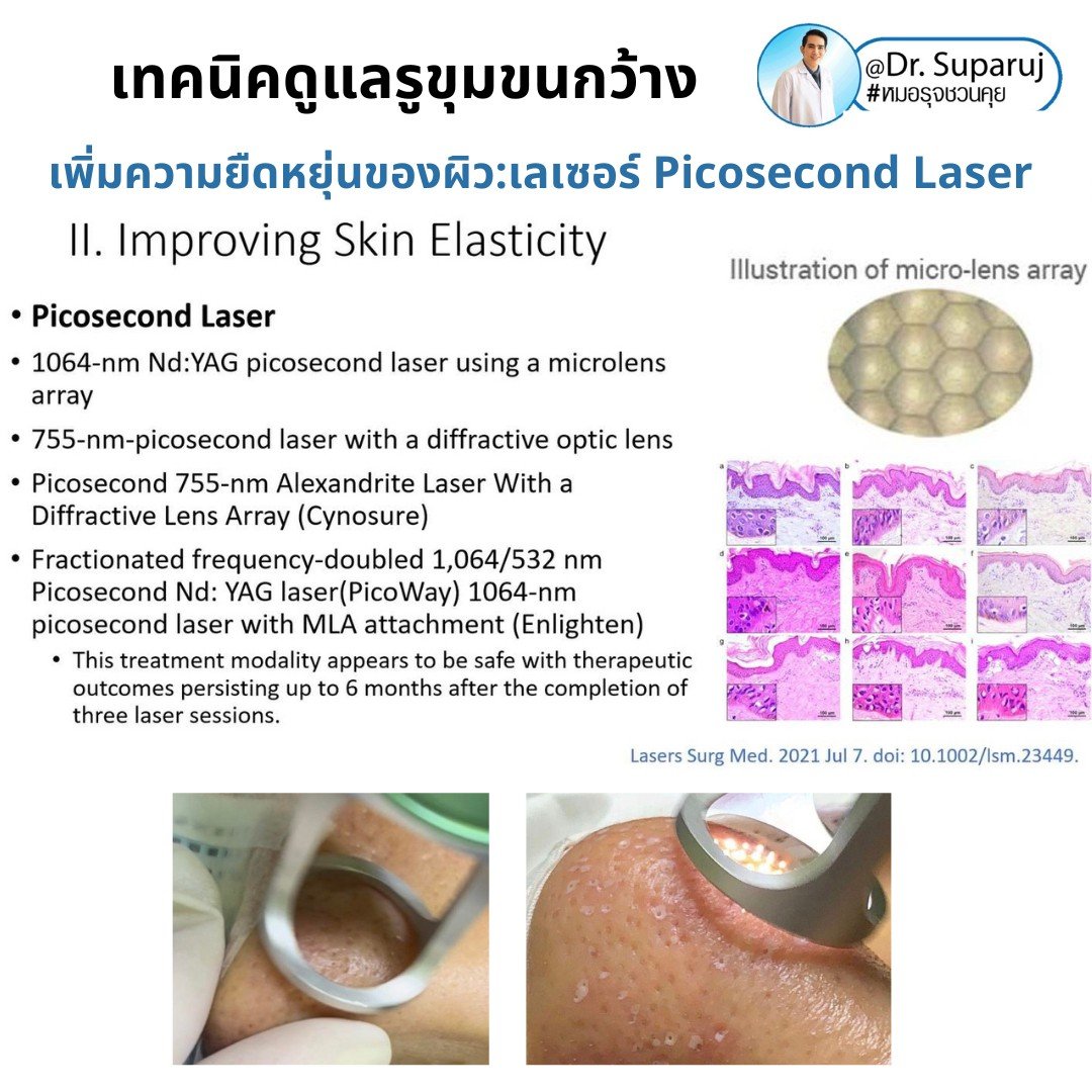 แนะนำเทคนิคดูแลรูขุมขนกว้าง: ตัวอย่างผลการดูแลรูขุมขนกว้าง Enlarged Facial Pore ด้วย MultiMode Picosecond Laser แนะนำเทคนิคดูแลรูขุมขนกว้าง: ตัวอย่างผลการดูแลรูขุมขนกว้าง Enlarged Facial Pore ด้วย MultiMode Picosecond Laser