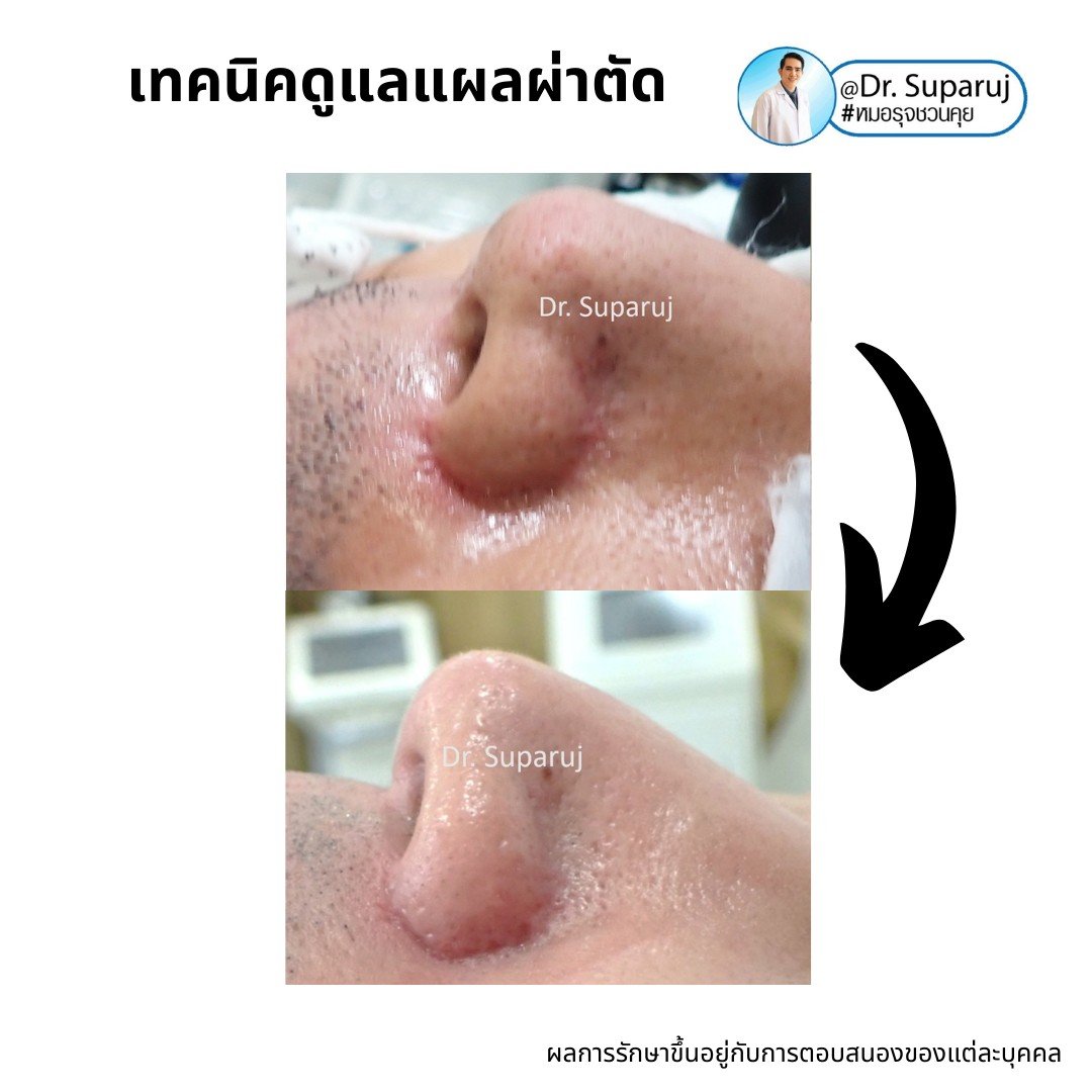 Update เทคนิคดูแลแผลเป็นนูนคีลอยด์ 2022 Update เทคนิคดูแลแผลเป็นนูนคีลอยด์ 2022