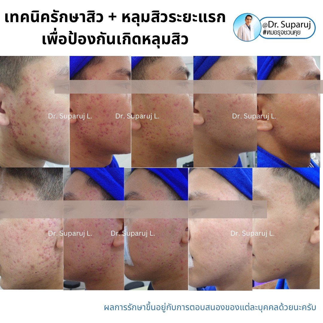 แนะนำเทคนิคดูแลรักษาสิวและหลุมสิว: ดูแลรอยแดงจากสิวและแผลเป็นยุบตัวจากสิว Acne + Macular acne erythema + Atrophic acne scar ดูแลด้วย Picosecond Laser + Healite + Medication แนะนำเทคนิคดูแลรักษาสิวและหลุมสิว: ดูแลรอยแดงจากสิวและแผลเป็นยุบตัวจากสิว Acne + Macular acne erythema + Atrophic acne scar ดูแลด้วย Picosecond Laser + Healite + Medication
