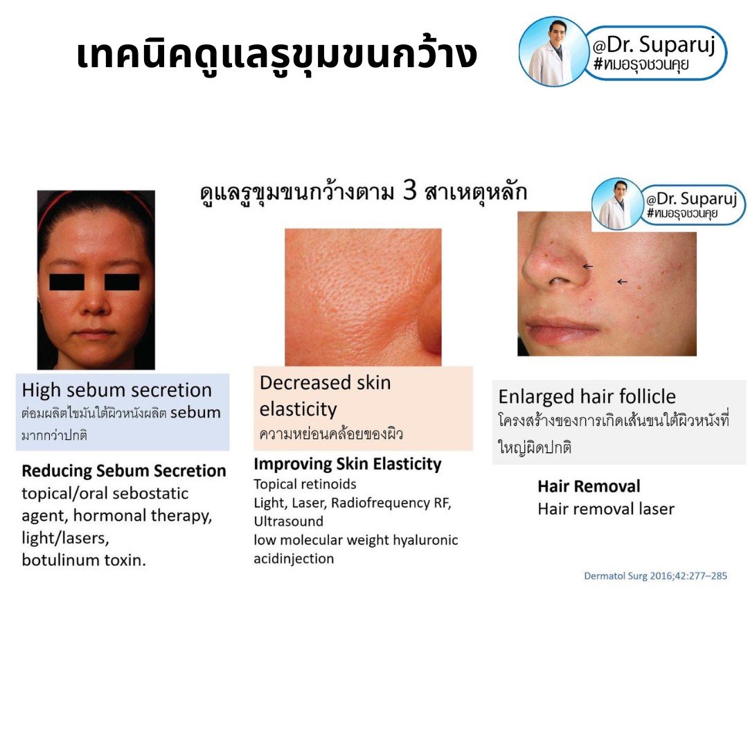แนะนำเทคนิคดูแลรูขุมขนกว้าง: ตัวอย่างผลการดูแลรูขุมขนกว้าง Enlarged Facial Pore ด้วย MultiMode Picosecond Laser แนะนำเทคนิคดูแลรูขุมขนกว้าง: ตัวอย่างผลการดูแลรูขุมขนกว้าง Enlarged Facial Pore ด้วย MultiMode Picosecond Laser