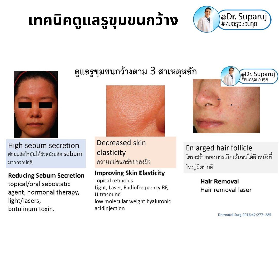 แนะนำเทคนิคดูแลรูขุมขนกว้าง: ตัวอย่างผลการดูแลรูขุมขนกว้าง Enlarged Facial Pore ด้วย MultiMode Picosecond Laser