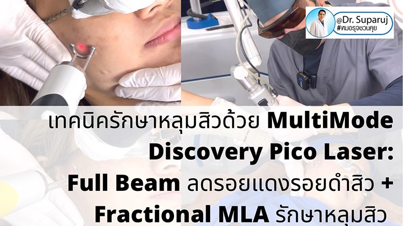 เทคนิครักษาหลุมสิวด้วย MultiMode Discovery Pico Laser: Full Beam ลดรอยแดงรอยดำสิว + Fractional MLA รักษาหลุมสิวครับ