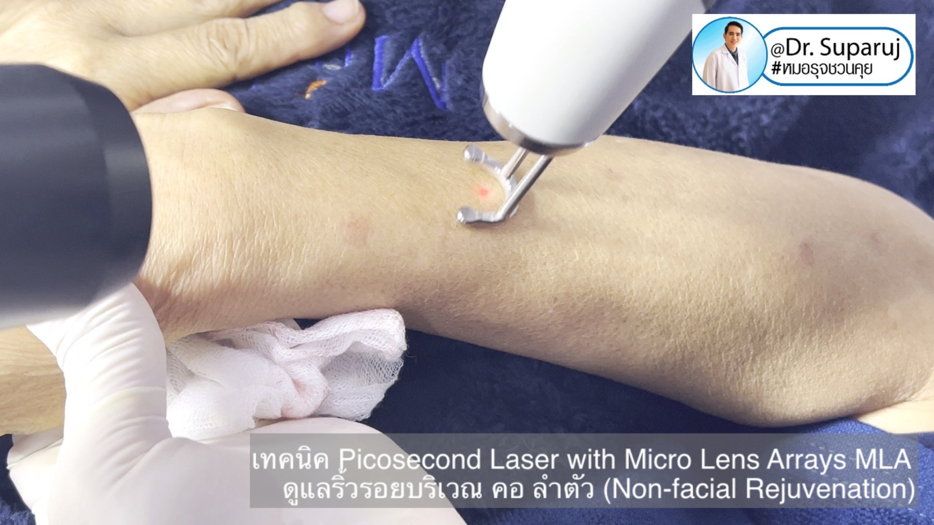 แนะนำ เทคนิคการใช้เลเซอร์ Picosecond Laser with Micro Lens Arrays MLA เพื่อดูแลริ้วรอยบริเวณ คอ ลำตัว (Non-facial rejuvenation)