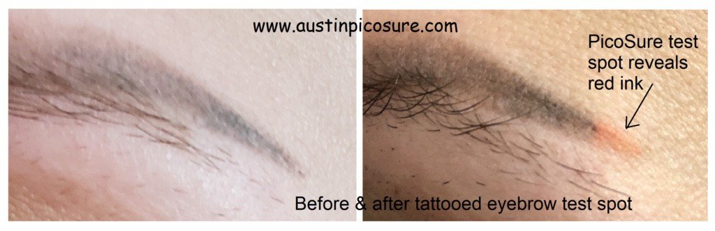 เทคนิคลบรอยสักคิ้ว ด้วยเลเซอร์ Picosecond Laser และลบรอยสักสีเนื้อต้องระวังอะไรบ้าง ? เทคนิคลบรอยสักคิ้ว ด้วยเลเซอร์ Picosecond Laser และลบรอยสักสีเนื้อต้องระวังอะไรบ้าง ?