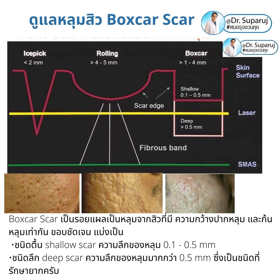 เทคนิคการดูแลหลุมสิว: ตัวอย่างการดูแลหลุมสิวแบบขอบชัดและแบบยุบตัวด้วยการใช้ Picosecond Laser + Perfusion Matrix Therapy