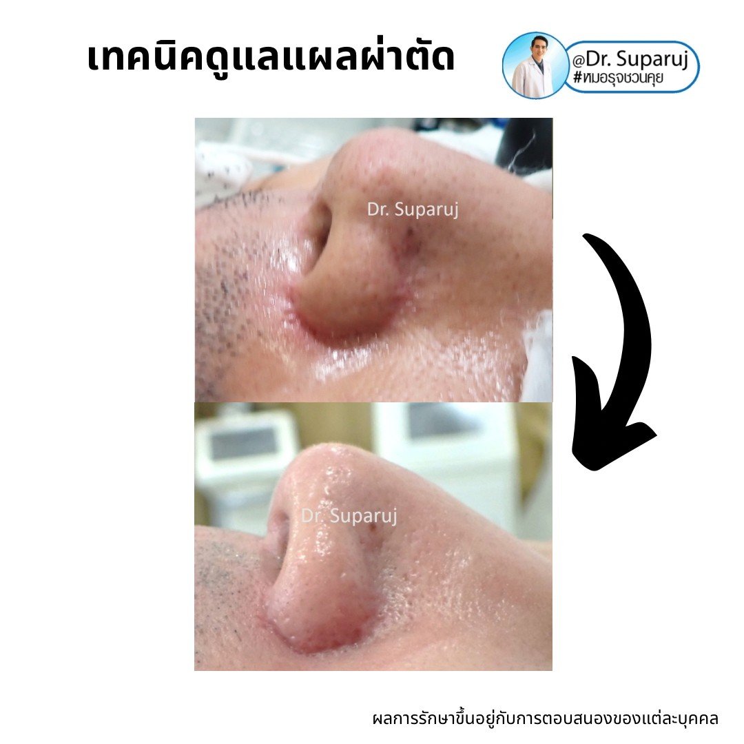 6 ปัจจัยที่ทำให้เกิดแผลเป็นนูนคีลอยด์ 6 ปัจจัยที่ทำให้เกิดแผลเป็นนูนคีลอยด์