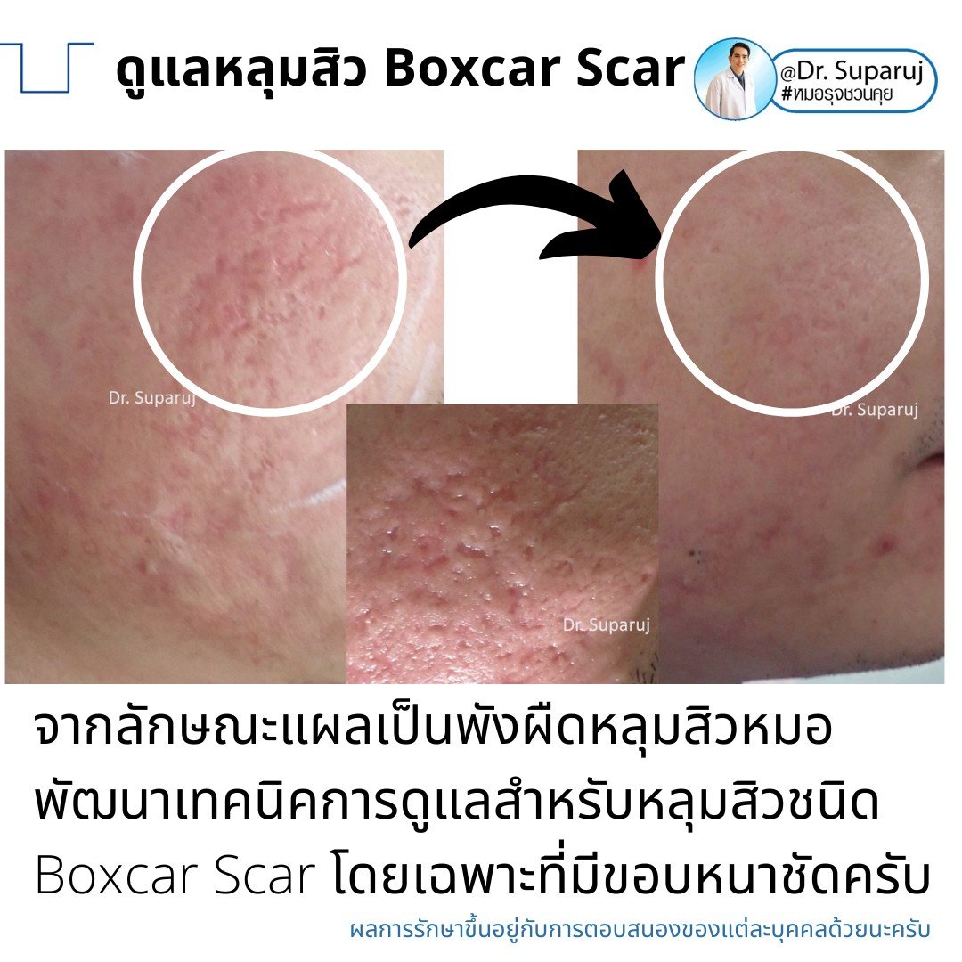 เทคนิคการดูแลหลุมสิว: ตัวอย่างการดูแลหลุมสิวแบบขอบชัดและแบบยุบตัวด้วยการใช้ Picosecond Laser + Perfusion Matrix Therapy เทคนิคการดูแลหลุมสิว: ตัวอย่างการดูแลหลุมสิวแบบขอบชัดและแบบยุบตัวด้วยการใช้ Picosecond Laser + Perfusion Matrix Therapy