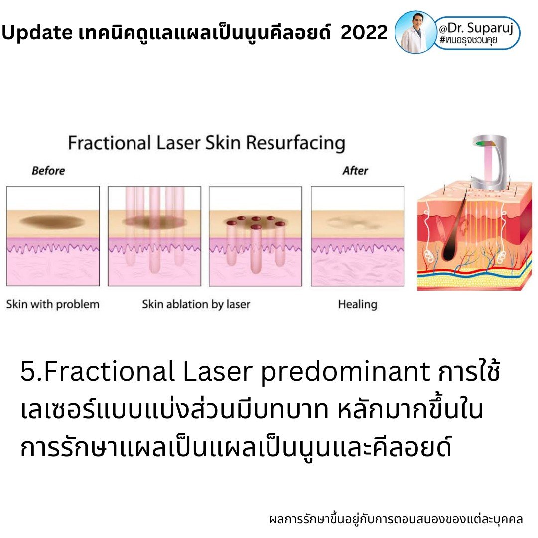 Update เทคนิคดูแลแผลเป็นนูนคีลอยด์ 2022