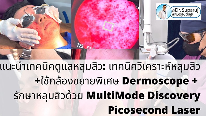 แนะนำเทคนิคดูแลหลุมสิว: เทคนิควิเคราะห์หลุมสิว +ใช้กล้องขยายพิเศษ Dermoscope + รักษาหลุมสิวด้วย MultiMode Discovery Picosecond Laser + Exosome Therapy