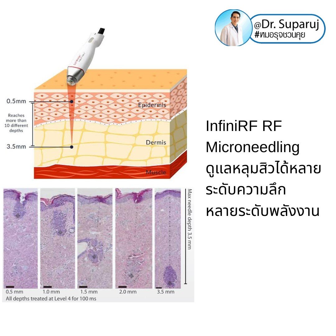 Update ผลการรักษาหลุมสิวด้วย Picosecond Laser VS InfiniRF Microneedle แตกต่างกันอย่างไร อันไหนมีประสิทธิภาพดีกว่า ?