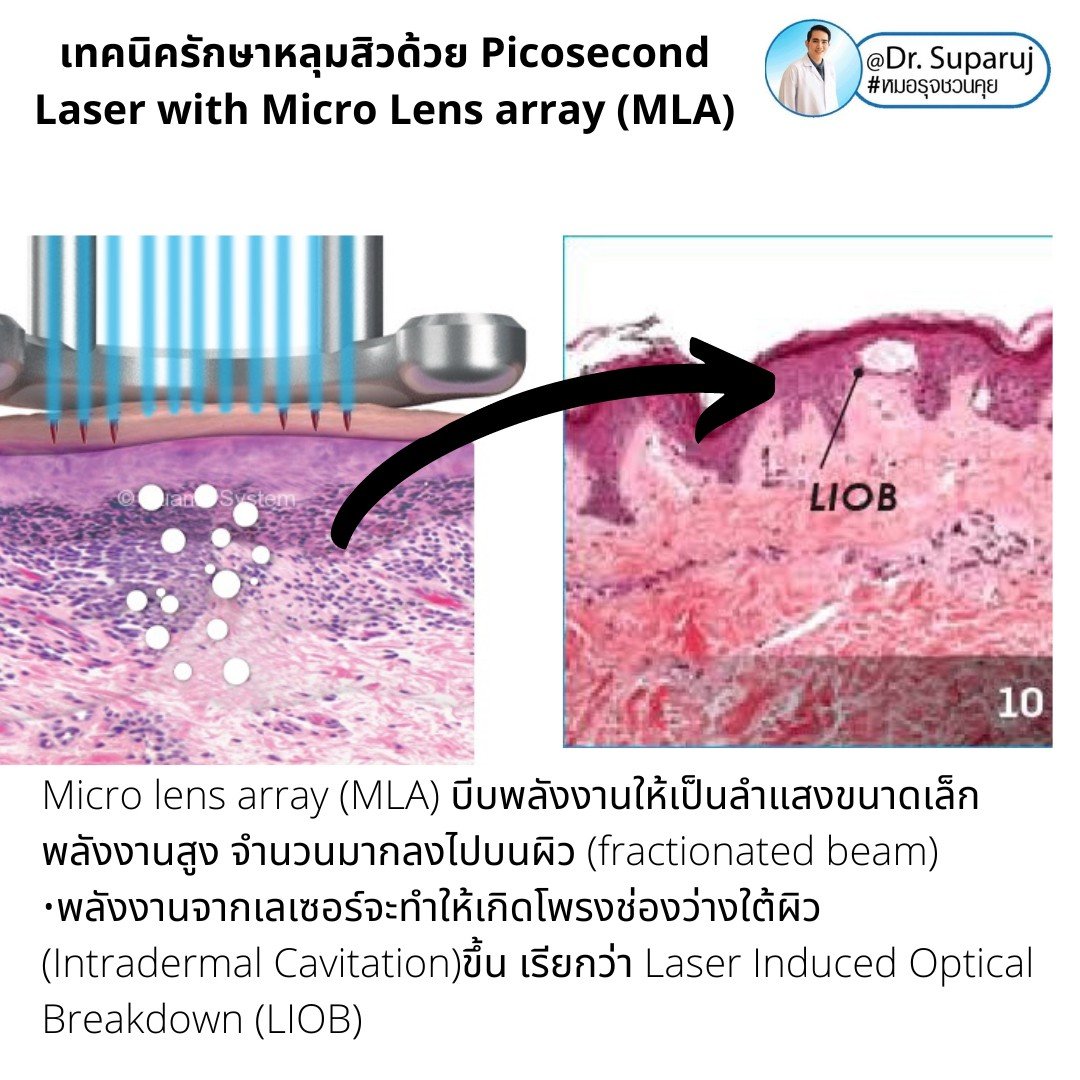 แนะนำเทคนิคดูแลหลุมสิว: Picosecond Laser แต่ละ Mode แตกต่างกันอย่างไร ?  ใช้ดูแลปัญหาไหน ชนิดไหนดีกว่ากัน: Full Beam/ Fractional MLA ?/ High Fluence/ Low Fluence