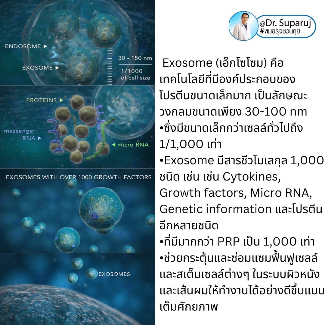 Exosome (เอ็กโซโซม) คือ เทคโนโลยีที่มีองค์ประกอบของโปรตีนขนาดเล็กมาก เป็นลักษณะวงกลมขนาดเพียง 30-100 nm ซึ่งมีขนาดเล็กกว่าเซลล์ทั่วไปถึง 1/1,000 เท่า โดยใน Exosome มีสารชีวโมเลกุล 1,000 ชนิด  Exosome (เอ็กโซโซม) คือ เทคโนโลยีที่มีองค์ประกอบของโปรตีนขนาดเล็กมาก เป็นลักษณะวงกลมขนาดเพียง 30-100 nm ซึ่งมีขนาดเล็กกว่าเซลล์ทั่วไปถึง 1/1,000 เท่า โดยใน Exosome มีสารชีวโมเลกุล 1,000 ชนิด