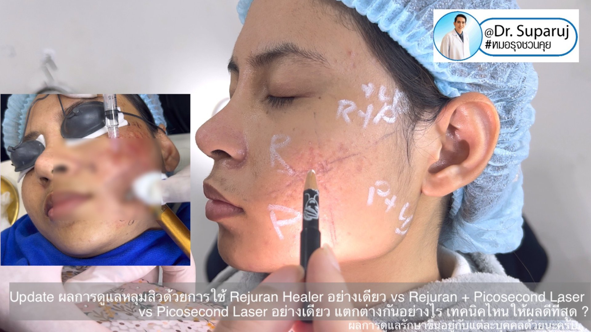 Update ผลการรักษาหลุมสิวด้วยเทคนิค Rejuran Healer อย่างเดียว vs Rejuran + Picosecond Laser vs Picosecond Laser อย่างเดียว แตกต่างกันอย่างไร เทคนิคไหนให้ผลดีที่สุด ? Update ผลการรักษาหลุมสิวด้วยเทคนิค Rejuran Healer อย่างเดียว vs Rejuran + Picosecond Laser vs Picosecond Laser อย่างเดียว แตกต่างกันอย่างไร เทคนิคไหนให้ผลดีที่สุด ?