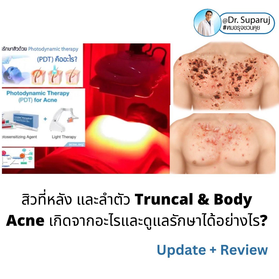 สิวที่หลัง และลำตัว Truncal & Body Acne เกิดจากอะไรและดูแลรักษาได้อย่างไร ? (Update + รีวิว) สิวที่หลัง และลำตัว Truncal & Body Acne เกิดจากอะไรและดูแลรักษาได้อย่างไร ? (Update + รีวิว)
