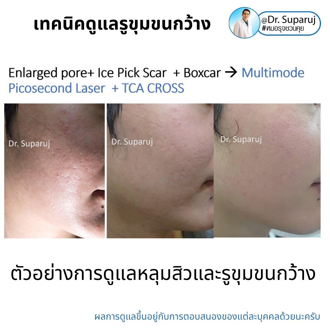 เทคนิควิเคราะห์ & รักษาขุมขนกว้าง Enlarged Facial Pore ด้วยกล้อส่องขยายพิเศษทางผิวหนัง Dermoscopy