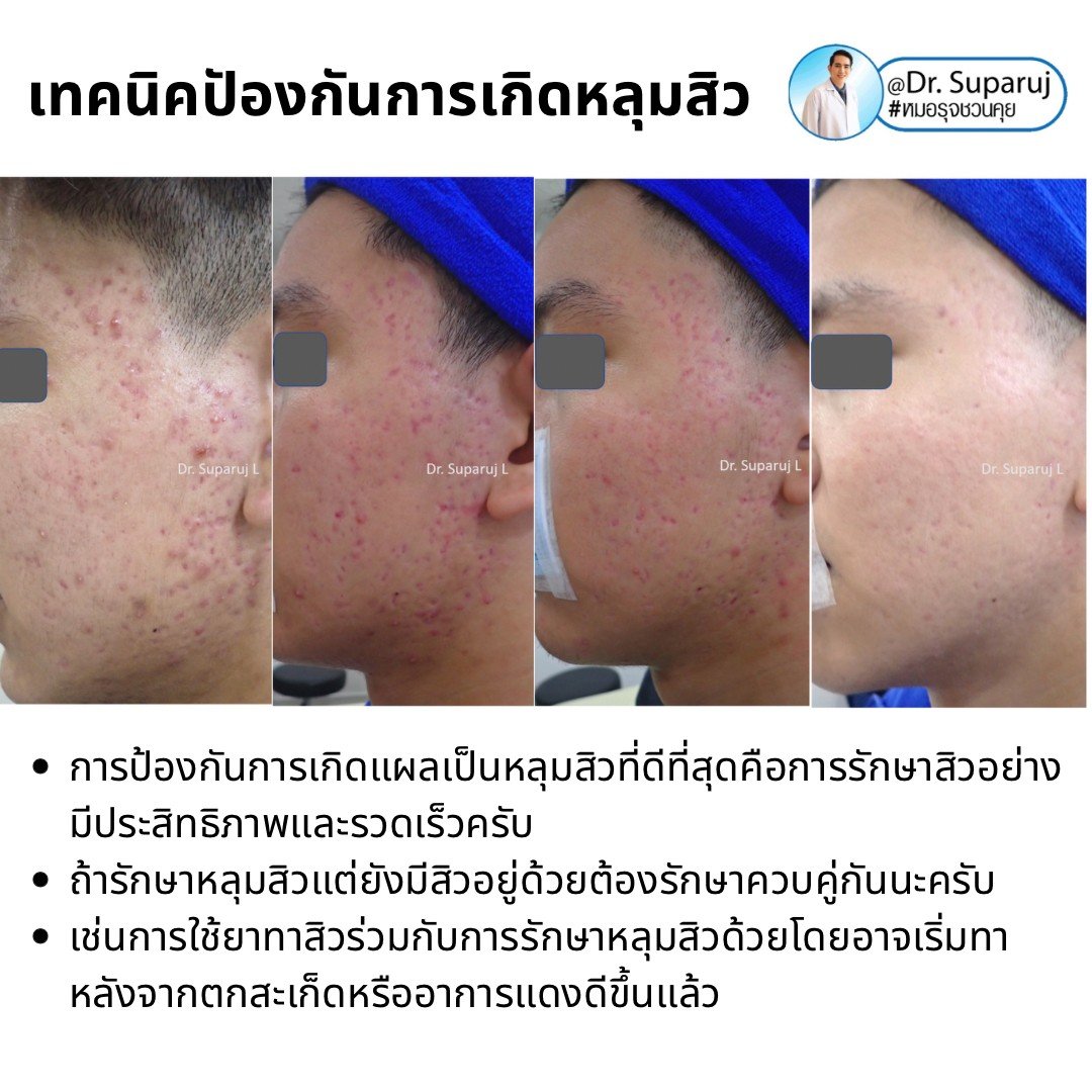 แนะนำเทคนิคการล้างหน้าตามแนวรูขุมขน/ โพรงขน เพื่อช่วยลดสิว รูขุมขนอักเสบ